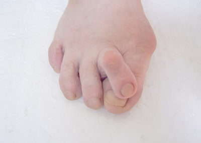 Common Foot Pain Inducing Conditions | Kann Foot Surgery, Essex